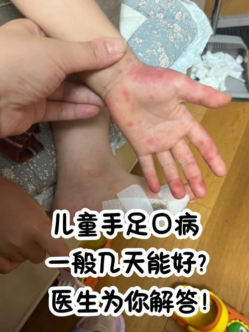 儿童手脚起红疹是过敏还是感染？家长该如何正确应对与护理？-第3张图片-郑州医学网