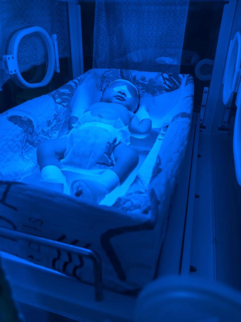 新生儿溶血性黄疸的严重程度如何判断？需要紧急治疗吗？-第1张图片-郑州医学网