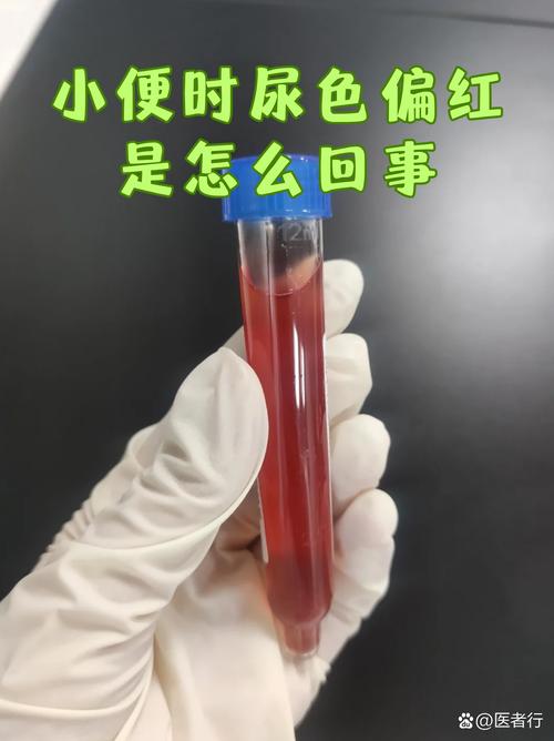 孕期尿液发红是身体发出的危险信号吗？-第2张图片-郑州医学网