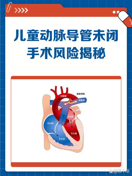 动脉导管未闭在新生儿中常见吗？发病率高不高？-第1张图片-郑州医学网