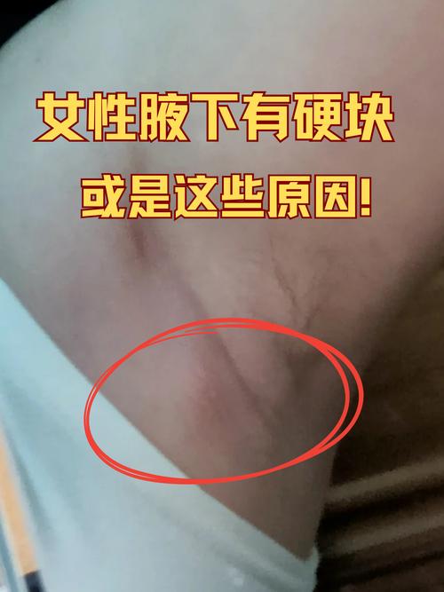 孕期腋下出现硬块且按压疼痛，是孕期激素变化还是乳腺病变的信号？-第2张图片-郑州医学网