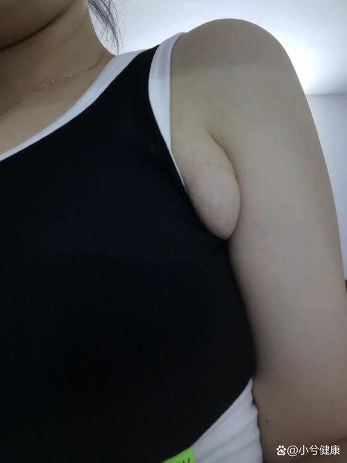 孕期腋下出现硬块且按压疼痛，是孕期激素变化还是乳腺病变的信号？-第3张图片-郑州医学网