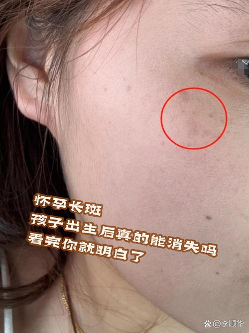 孕期脸上长斑怎么办?5个科学预防方法让你孕期肌肤依然白皙!-第3张图片-郑州医学网 孕期脸上长斑怎么办?5个科学预防方法让你孕期肌肤依然白皙!-第3张图片-郑州医学网