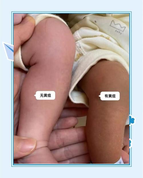 新生儿黄疸过高会损伤大脑吗？家长该如何应对这些潜在风险？-第1张图片-郑州医学网