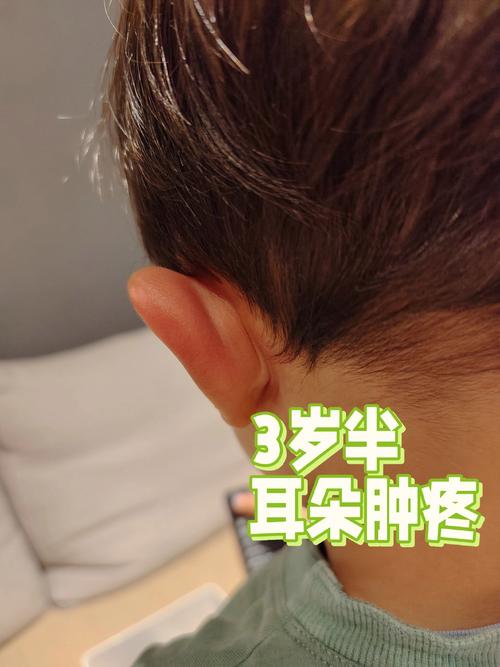 儿童耳朵下面突然肿了，是淋巴结发炎还是其他急症？-第3张图片-郑州医学网