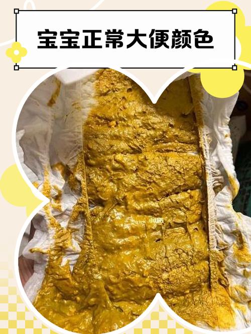 新生儿拉黄绿色便便是正常现象还是健康预警？-第1张图片-郑州医学网