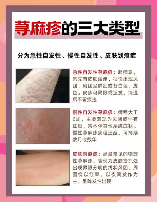 孕期荨麻疹会持续多久？对胎儿有影响吗？如何有效缓解？-第2张图片-郑州医学网