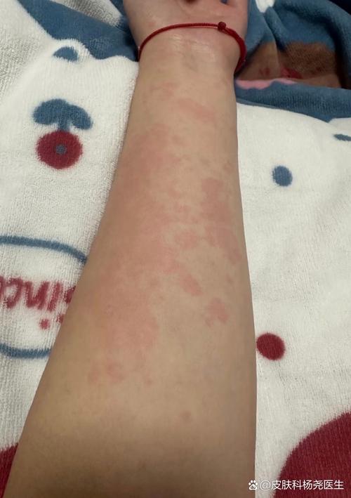 孕期荨麻疹会持续多久？对胎儿有影响吗？如何有效缓解？-第3张图片-郑州医学网