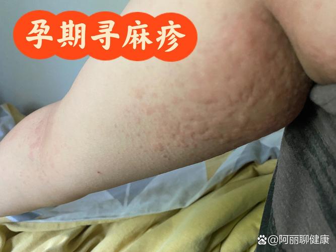 孕期荨麻疹会持续多久？对胎儿有影响吗？如何有效缓解？-第1张图片-郑州医学网