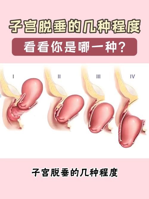 孕期子宫脱落是严重疾病吗？对母婴有哪些危害？如何预防与治疗？-第3张图片-郑州医学网