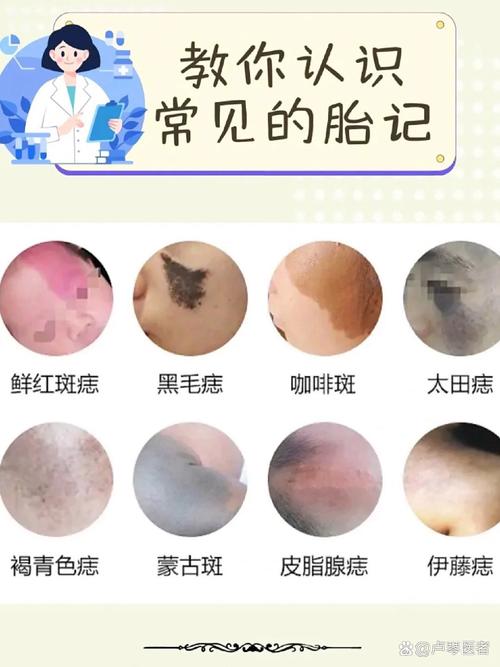 孕期胎记形成是孕期激素波动还是胎儿皮肤发育异常导致的？-第3张图片-郑州医学网