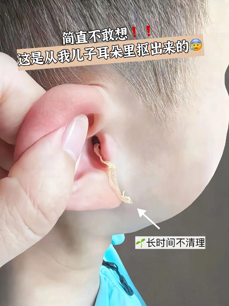儿童耳朵痒痒是上火还是感染？家长该如何正确处理和预防？-第1张图片-郑州医学网