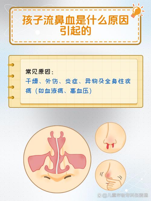 儿童夜间流鼻血是上火还是疾病信号？家长该如何科学应对？-第1张图片-郑州医学网