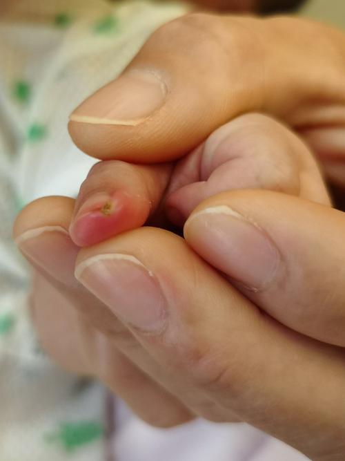 新生儿剪指甲剪到肉怎么办？新手爸妈该如何正确护理避免受伤？-第2张图片-郑州医学网