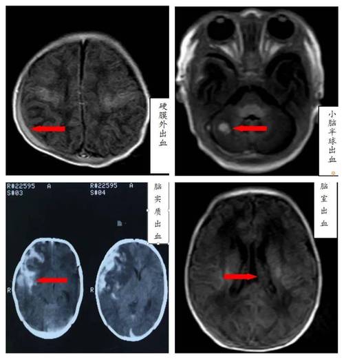 新生儿颅内蛛网膜出血的成因、危害及早期干预措施有哪些？-第1张图片-郑州医学网