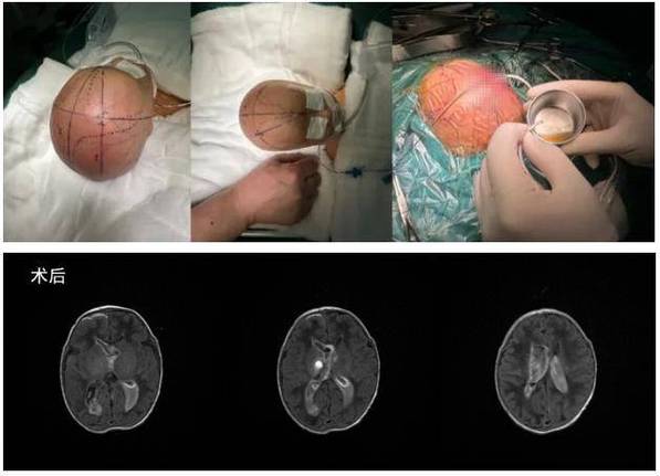 新生儿颅内蛛网膜出血的成因、危害及早期干预措施有哪些？-第2张图片-郑州医学网