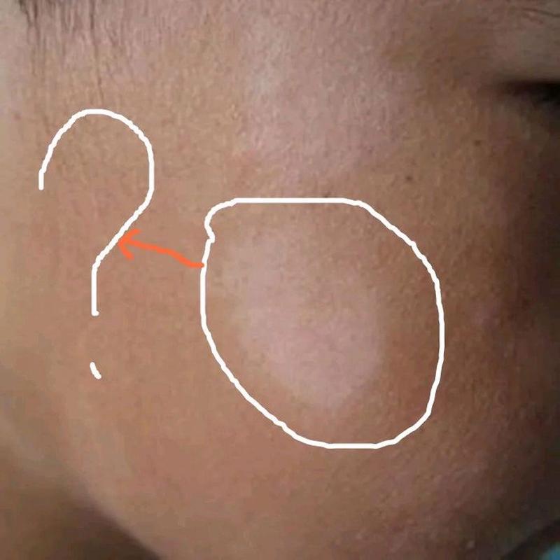 新生儿脸上出现白色斑块是正常现象还是疾病信号?-第2张图片-郑州医学网 新生儿脸上出现白色斑块是正常现象还是疾病信号?-第2张图片-郑州医学网