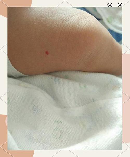 新生儿腿上长血管瘤，家长该注意什么？会自行消退吗？需要治疗吗？-第1张图片-郑州医学网