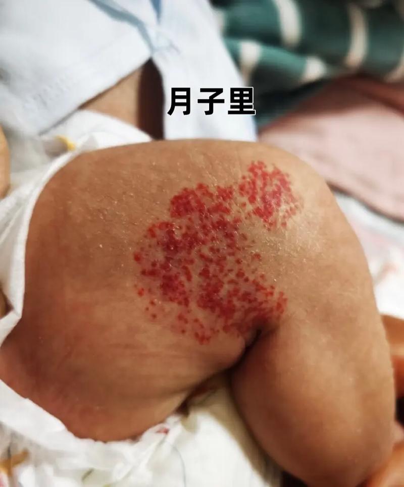 新生儿腿上长血管瘤，家长该注意什么？会自行消退吗？需要治疗吗？-第2张图片-郑州医学网