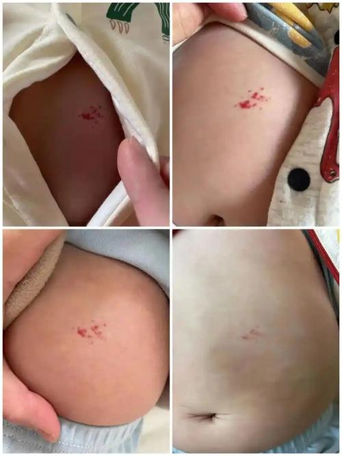 新生儿腿上长血管瘤，家长该注意什么？会自行消退吗？需要治疗吗？-第3张图片-郑州医学网