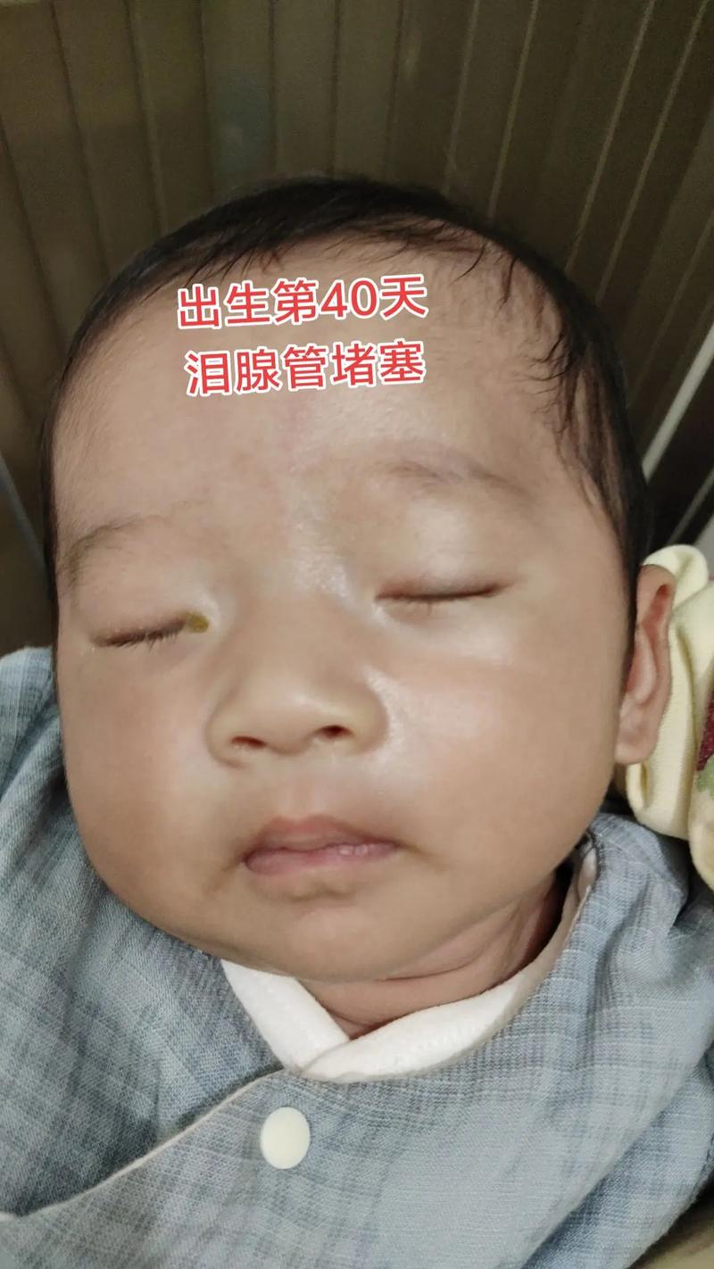 新生儿眼角总有眼泪眼屎，是上火还是眼睛发炎了？-第2张图片-郑州医学网