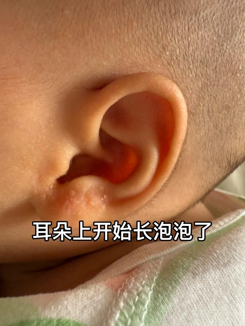 新生儿外耳道湿疹反复发作，究竟是什么原因在作祟？-第2张图片-郑州医学网
