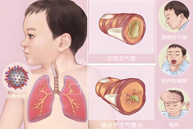 儿童支气管扩张有哪些典型症状？家长该如何早期识别与应对？-第2张图片-郑州医学网