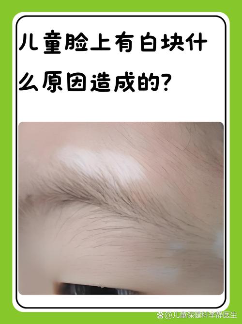 新生儿眼白发黄是正常现象吗？需要警惕哪些潜在健康问题？-第3张图片-郑州医学网