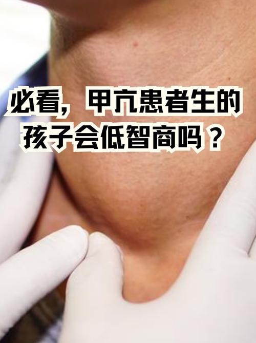 儿童甲状腺肿大到底严不严重？会不会影响生长发育？-第3张图片-郑州医学网