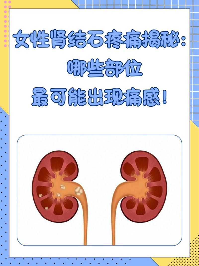 孕期肾结石来袭，身体会发出哪些异常信号？-第2张图片-郑州医学网