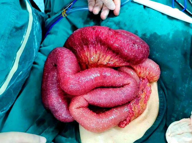 儿童肠结节有哪些典型症状？家长该如何早期识别与应对？-第3张图片-郑州医学网