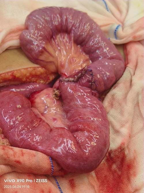 儿童肠结节有哪些典型症状？家长该如何早期识别与应对？-第2张图片-郑州医学网