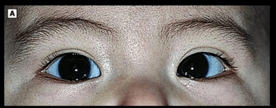 新生儿眼睛呈现蓝色是正常现象吗？会随时间变化吗？-第2张图片-郑州医学网