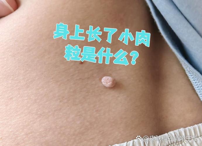 孕期身上莫名长小肉疙瘩，是激素变化还是皮肤病变？需要担心吗？-第3张图片-郑州医学网