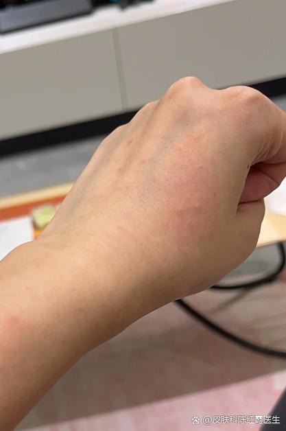 孕期身上莫名长小肉疙瘩，是激素变化还是皮肤病变？需要担心吗？-第2张图片-郑州医学网