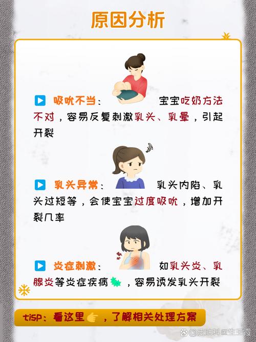 孕期乳头皲裂是何原因导致？如何有效缓解与预防？-第2张图片-郑州医学网