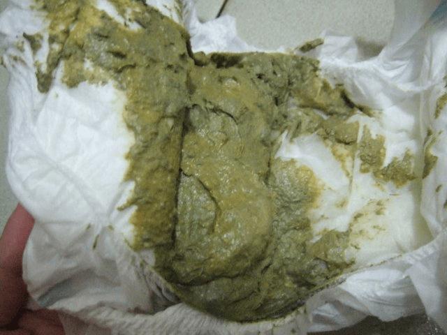 新生儿24小时未排便,是正常生理现象还是需要警惕的健康信号?-第3张图片-郑州医学网 新生儿24小时未排便,是正常生理现象还是需要警惕的健康信号?-第3张图片-郑州医学网