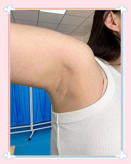 孕期腋下变黑多久能好？产后会自行消退吗？如何加速恢复？-第3张图片-郑州医学网