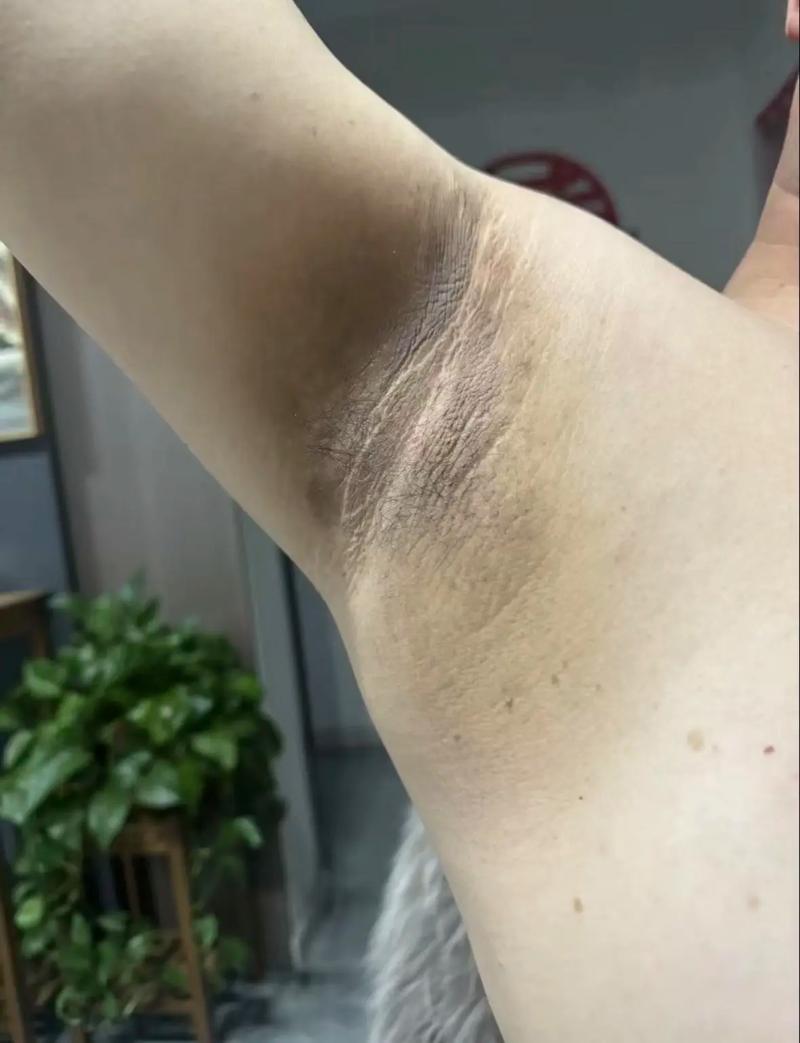 孕期腋下变黑多久能好？产后会自行消退吗？如何加速恢复？-第1张图片-郑州医学网