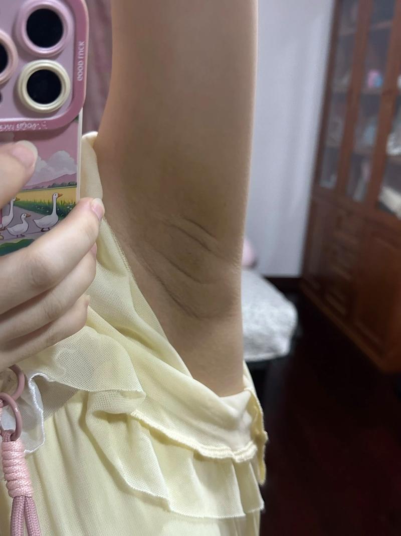 孕期腋下变黑多久能好？产后会自行消退吗？如何加速恢复？-第2张图片-郑州医学网