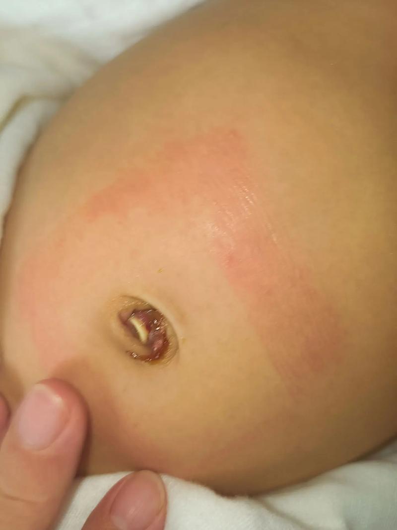 新生儿肚脐发红是正常现象吗？需要警惕哪些潜在问题？-第2张图片-郑州医学网