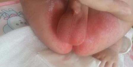 儿童尿路感染症状图片有哪些？如何通过图片辨别与普通尿路不适的区别？-第3张图片-郑州医学网