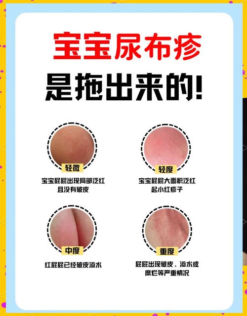 儿童尿路感染症状图片有哪些？如何通过图片辨别与普通尿路不适的区别？-第1张图片-郑州医学网