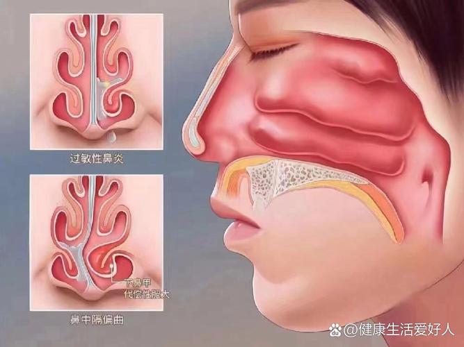 孕期鼻甲水肿之谜，激素变化如何引发鼻腔不适？-第3张图片-郑州医学网