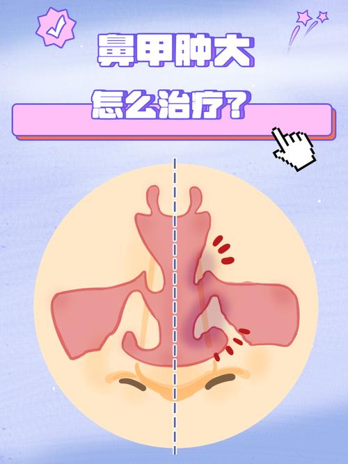 孕期鼻甲水肿之谜，激素变化如何引发鼻腔不适？-第1张图片-郑州医学网