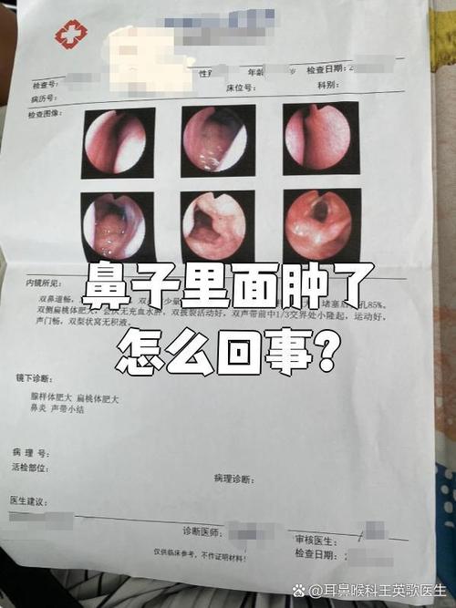 孕期鼻甲水肿之谜，激素变化如何引发鼻腔不适？-第2张图片-郑州医学网