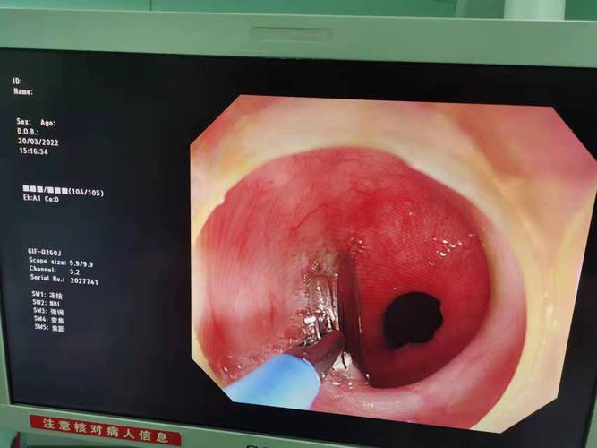 儿童胃镜取硬币痛苦吗？麻醉安全吗？家长该如何做？-第2张图片-郑州医学网