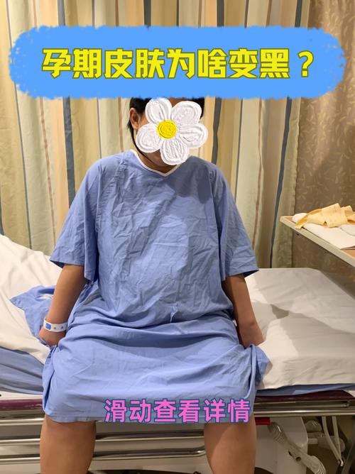 孕期全身皮肤变黑是激素变化还是疾病信号？需如何应对与改善？-第2张图片-郑州医学网