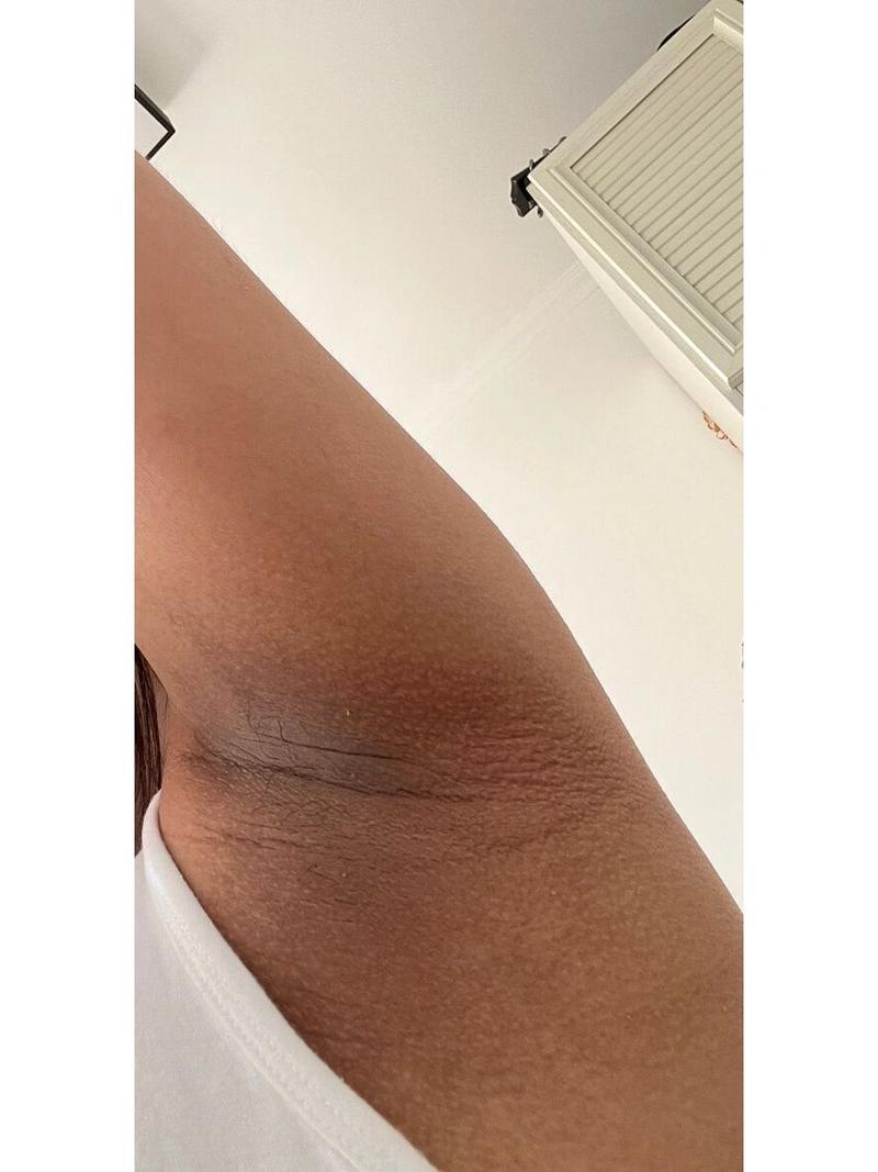 孕期全身皮肤变黑是激素变化还是疾病信号？需如何应对与改善？-第3张图片-郑州医学网