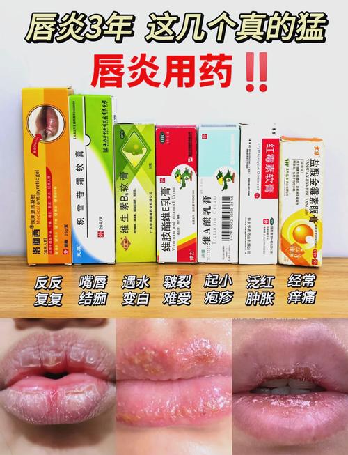 儿童嘴角烂了到底该抹什么药？不同情况用药有讲究吗？-第2张图片-郑州医学网